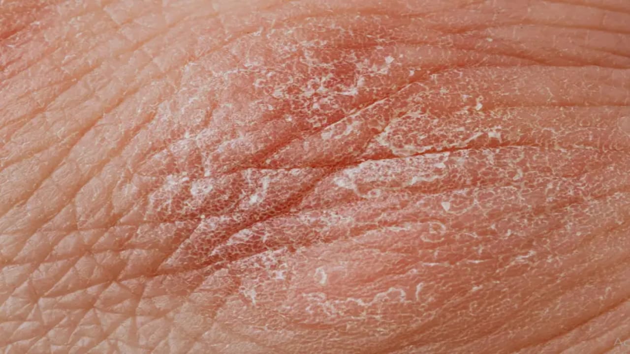 Memahami Psoriasis: Penyebab, Gejala, dan Pengobatan